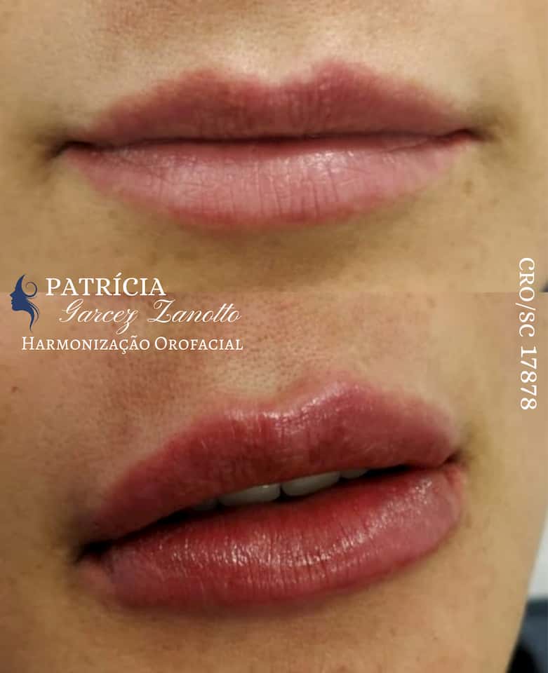 Preenchimento Labial com Ácido Hialurônico